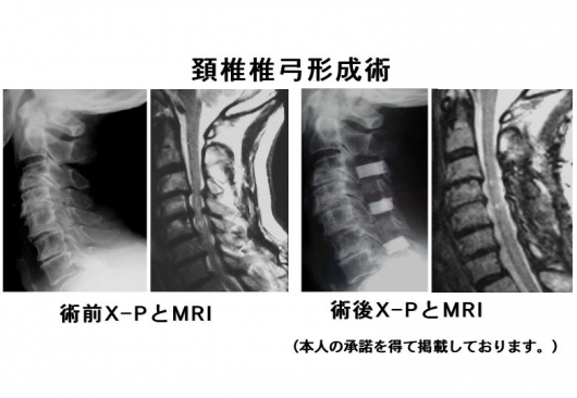 頚椎症性脊髄症