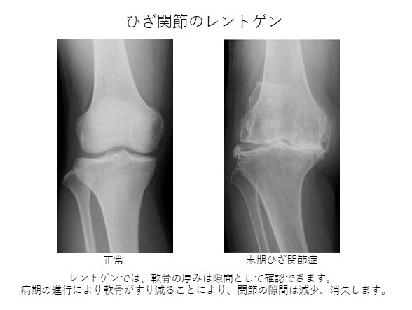 変形性膝関節症